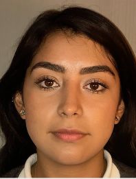 Rhinoplasty