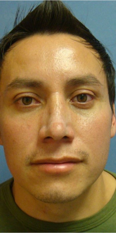 Rhinoplasty