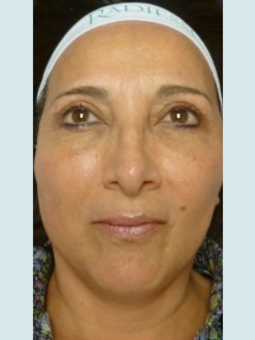 Facelift with Blepharoplasty