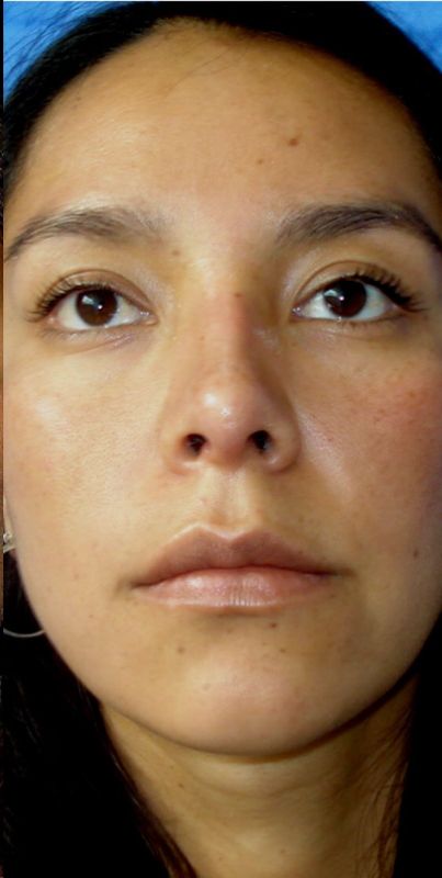 Rhinoplasty
