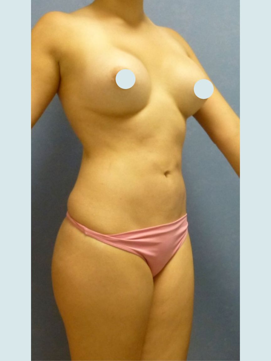 Liposuction