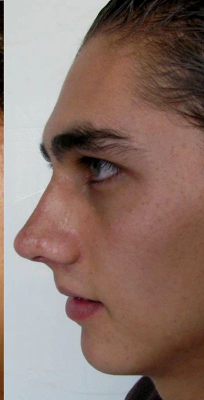 Rhinoplasty
