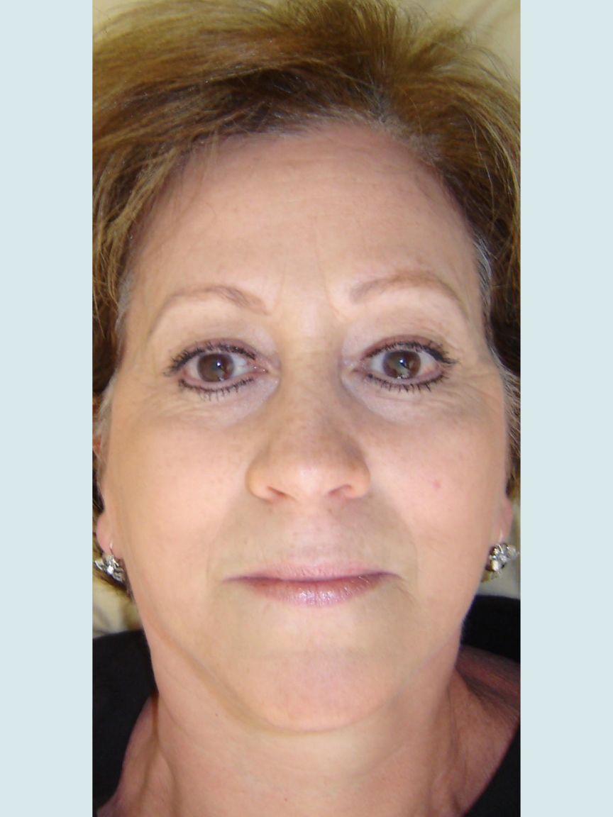Facelift