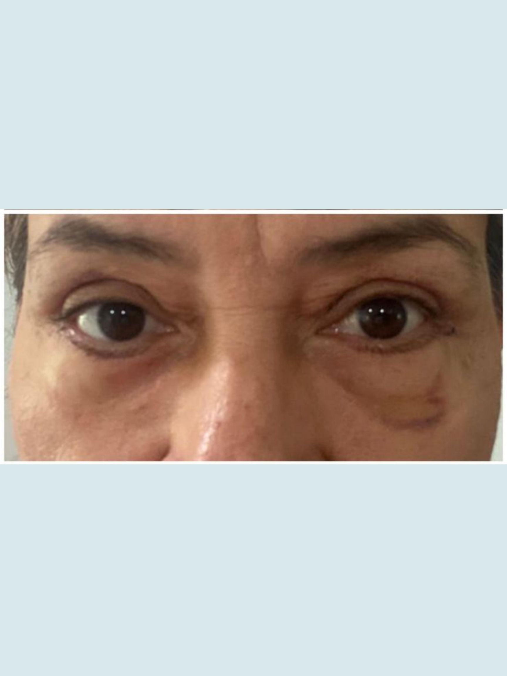 Eyelid Surgery