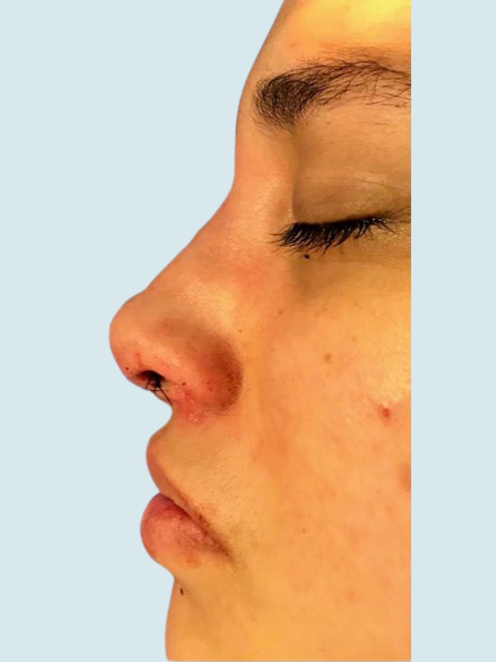 Rhinoplasty