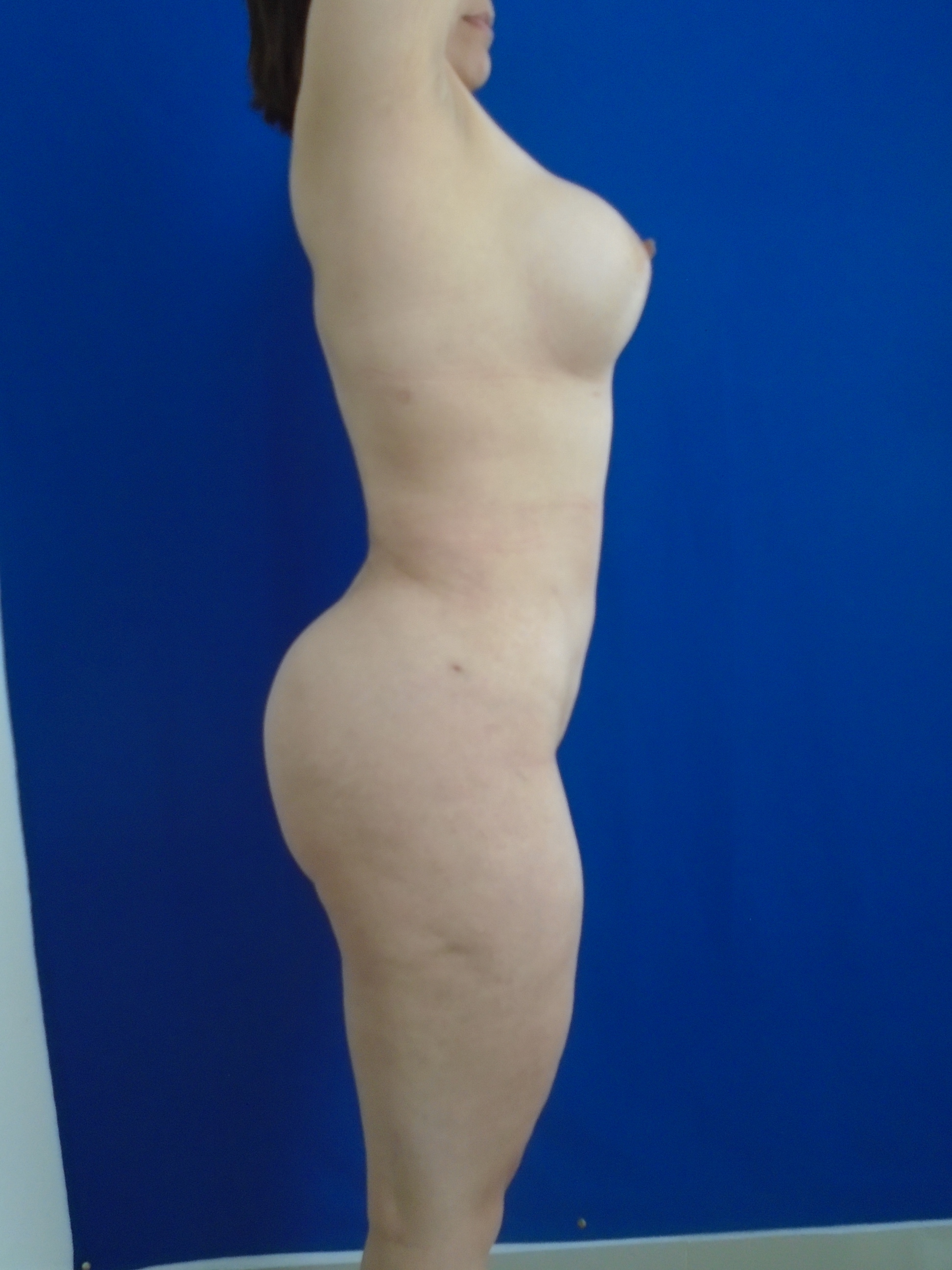 Liposuction