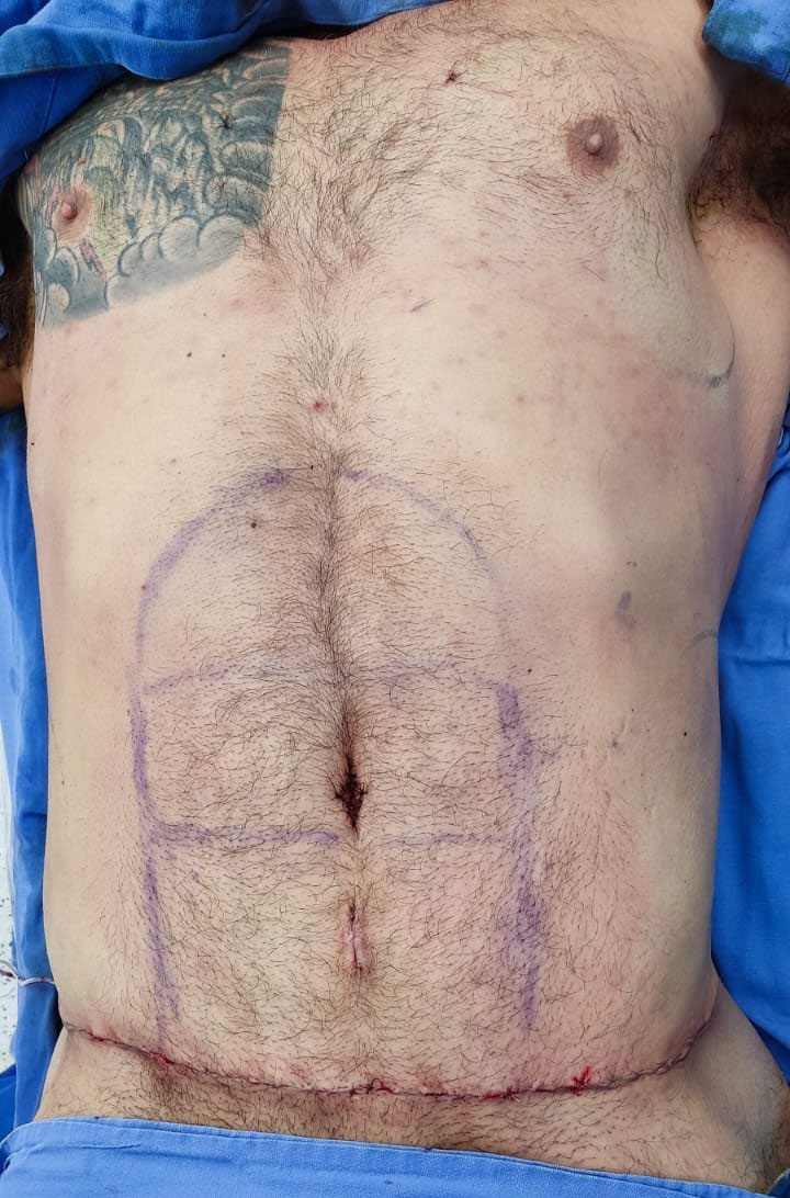 Tummy Tuck