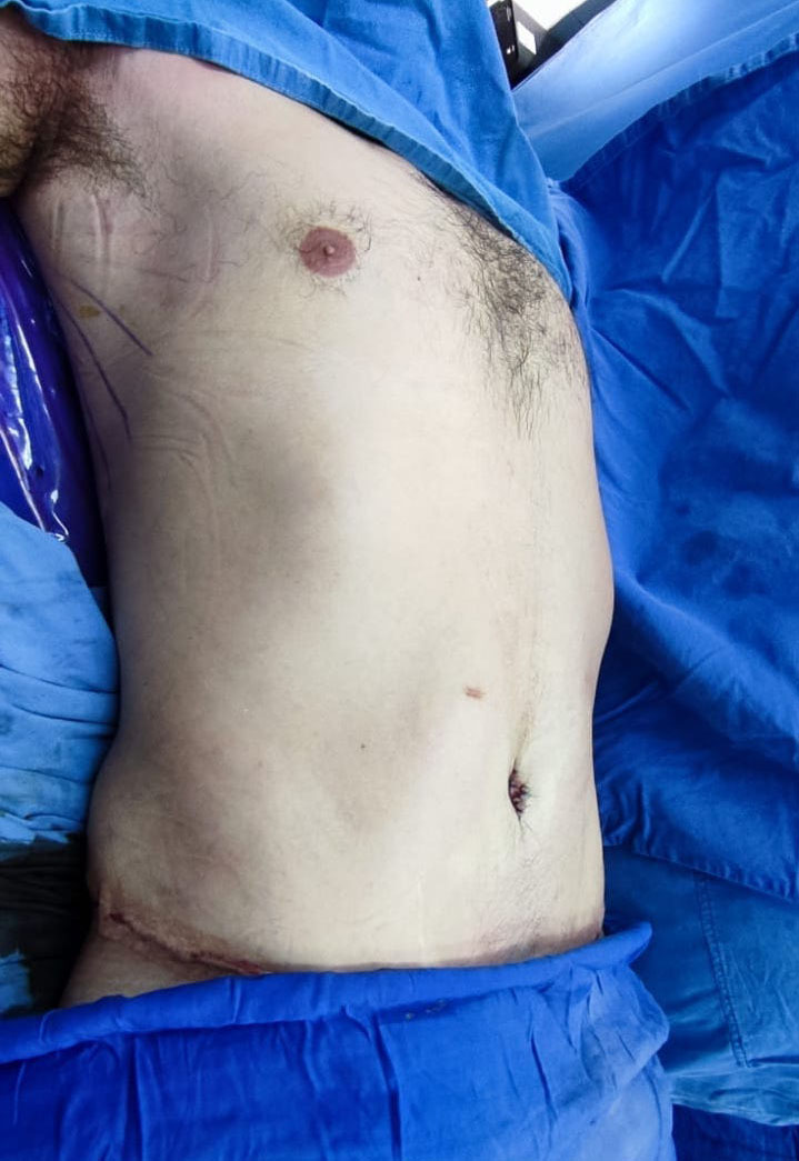 Tummy Tuck