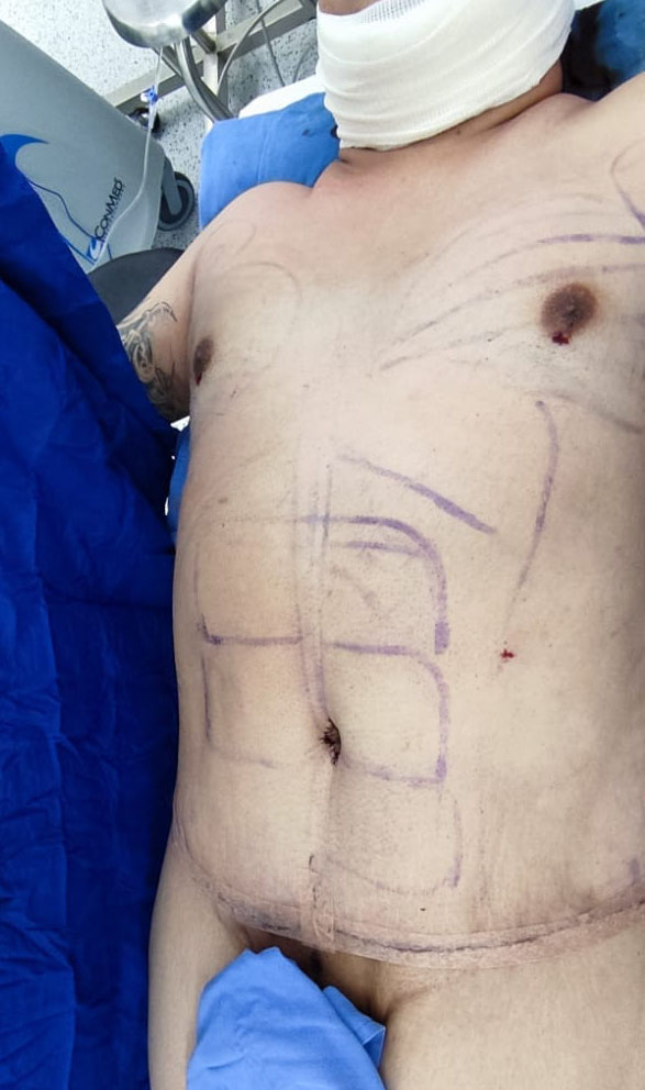 Tummy Tuck