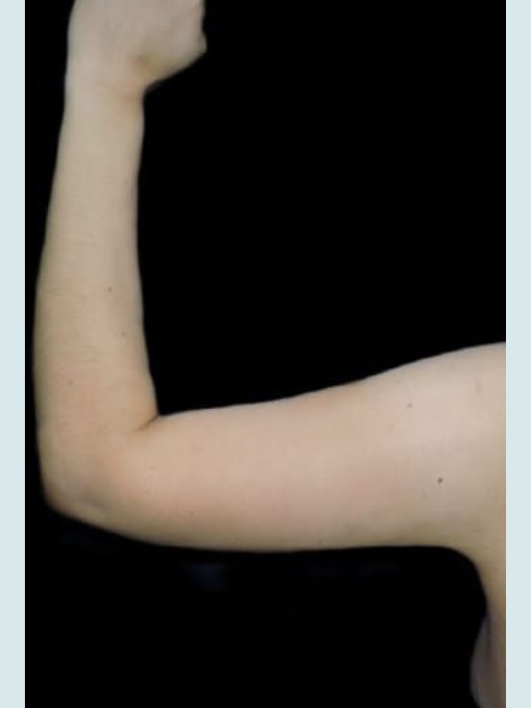 Arm Lift