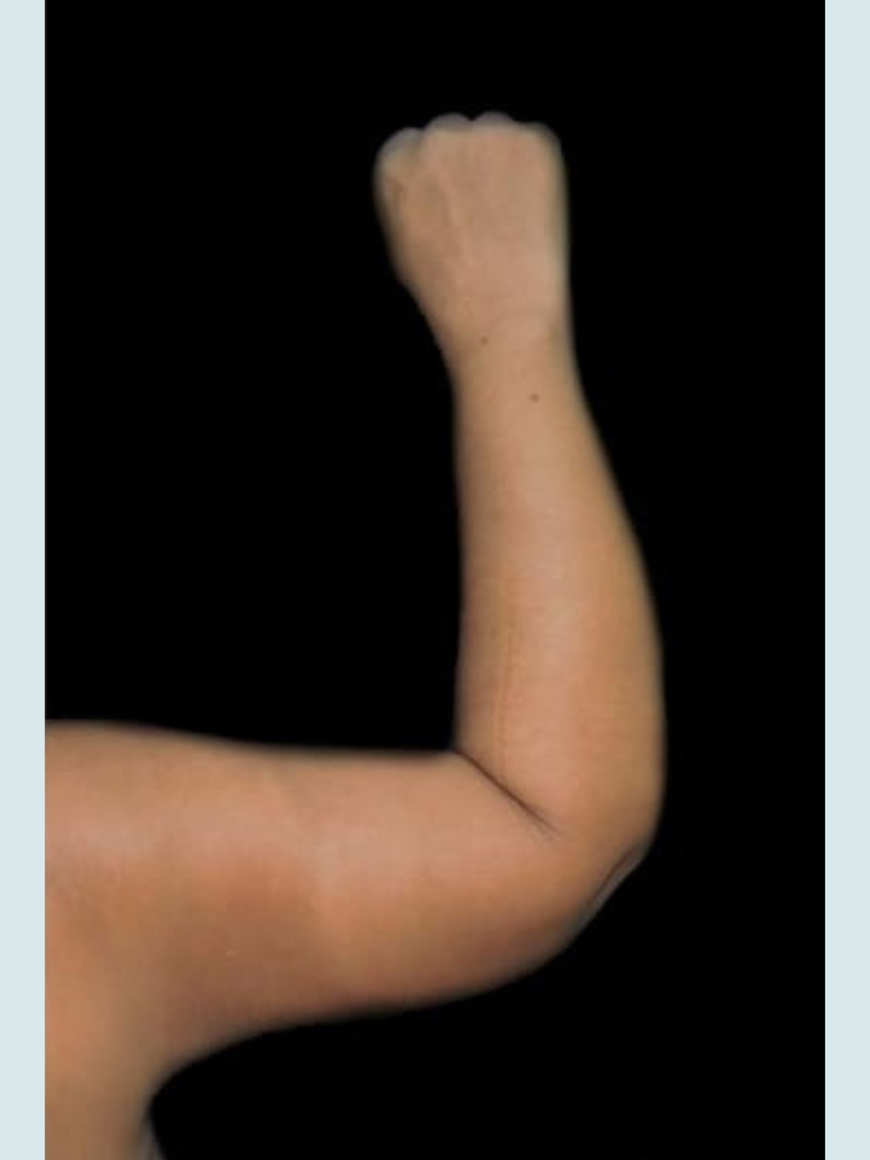Arm Lift