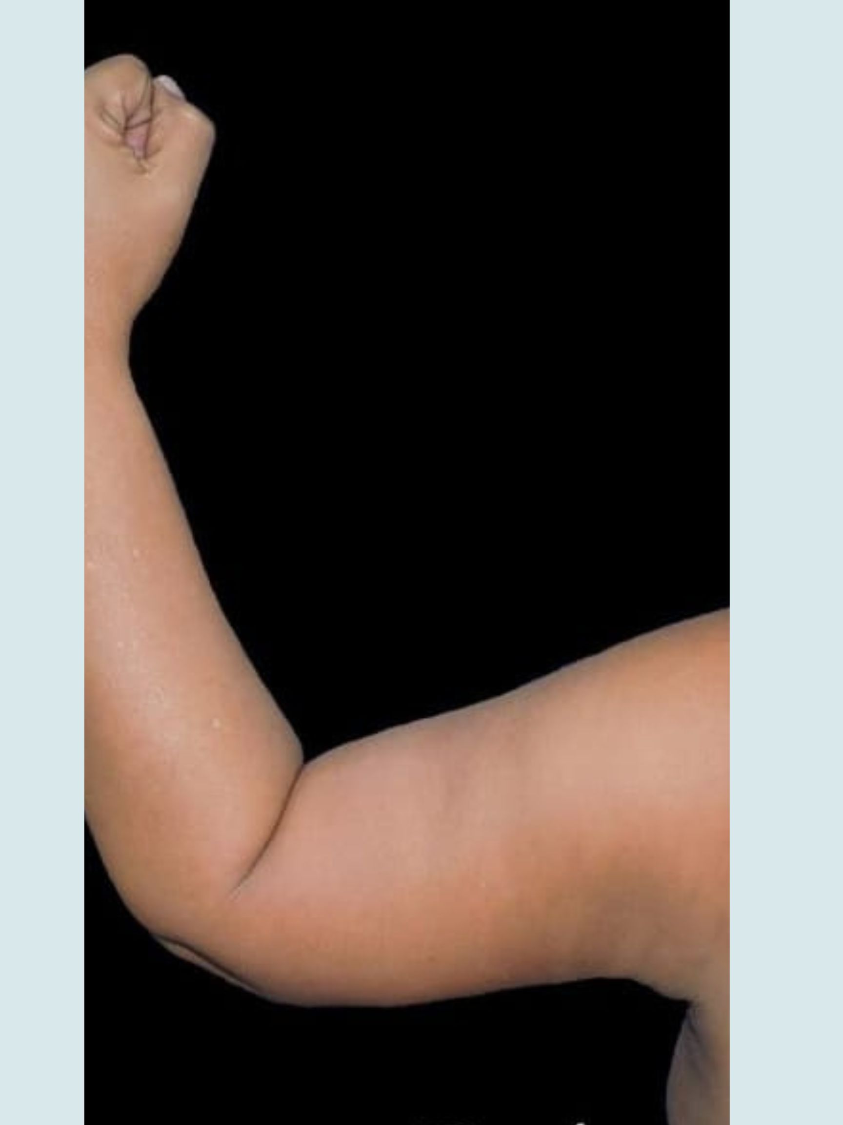 Arm Lift