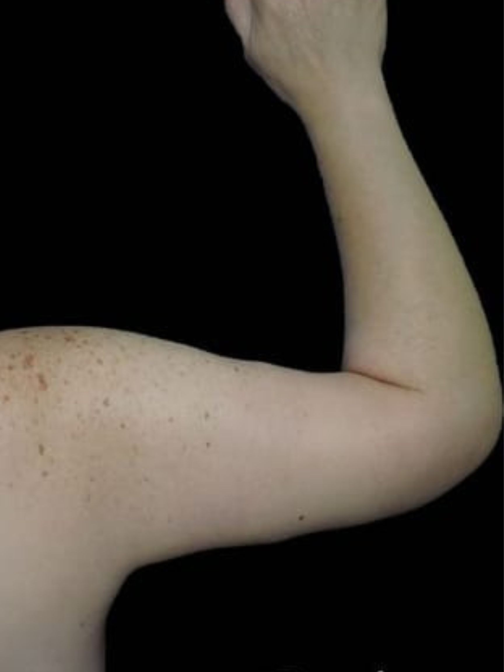 Arm Lift