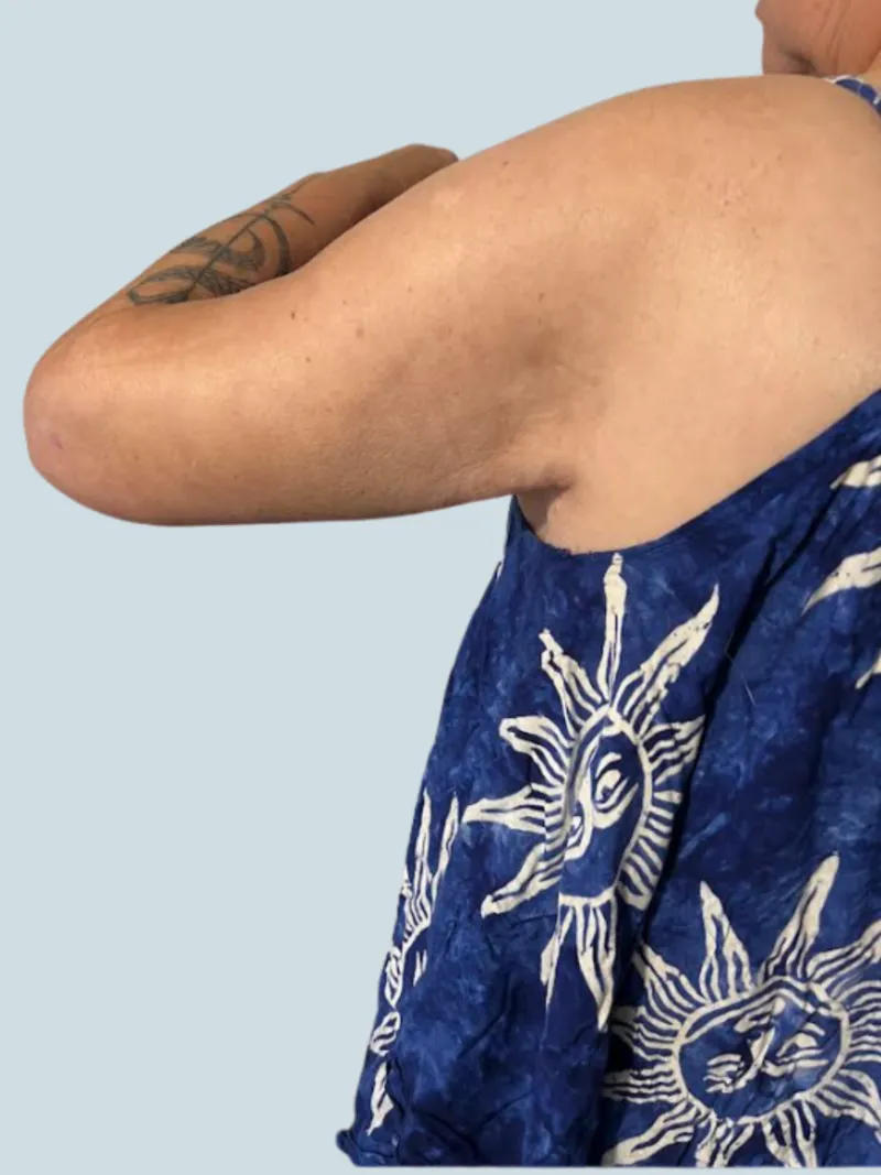 Arm Lift