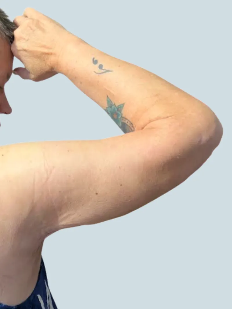 Arm Lift