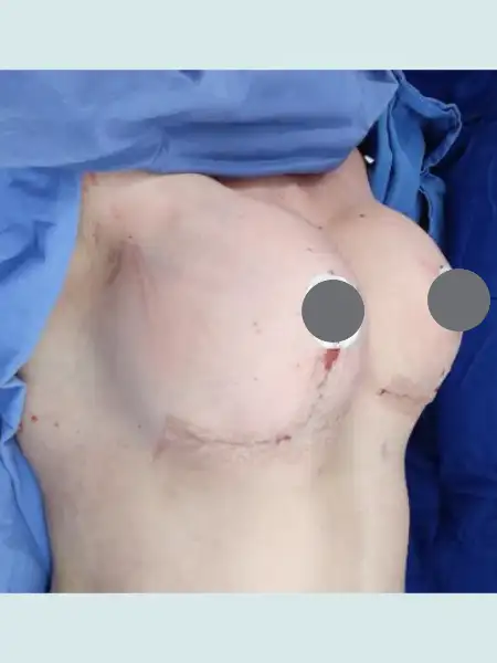 Breast Lift