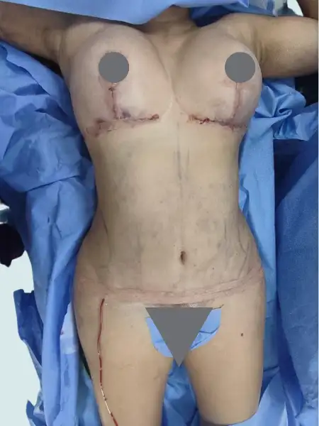 Breast Lift without implants and Tummy Tuck with Lipo 360