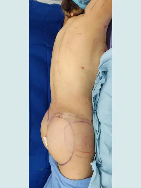Extended Tummy Tuck with Lipo 360 and BBL and Breast Implants