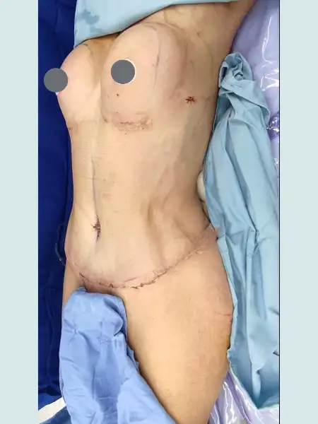 Extended Tummy Tuck with Lipo 360 and BBL and Breast Implants