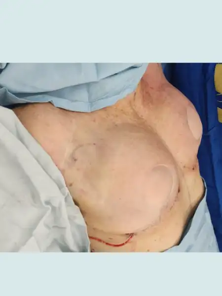 Implant Retirement Breast Lift with Fat Transfer