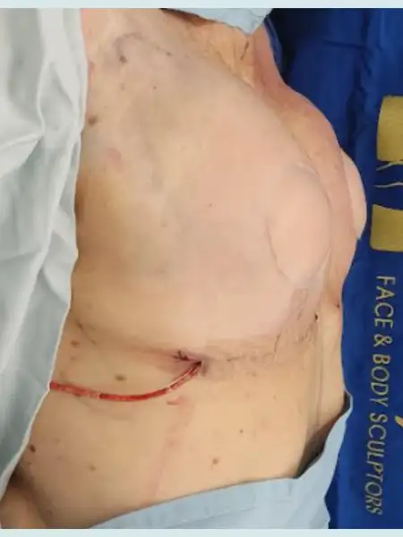 Implant Retirement Breast Lift with Fat Transfer