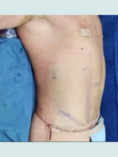 Male Circular Tummy Tuck with Lipo 360