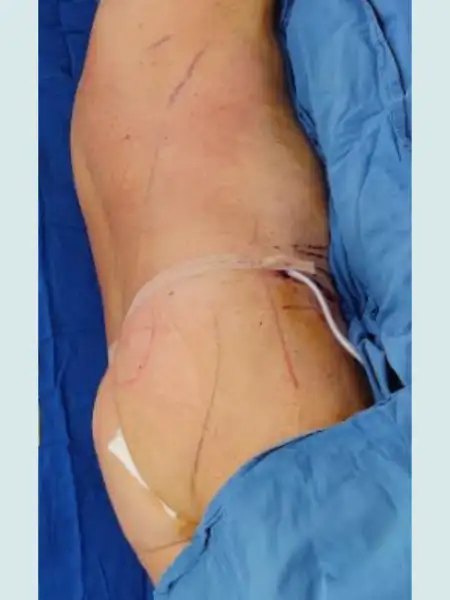 Male Circular Tummy Tuck with Lipo 360