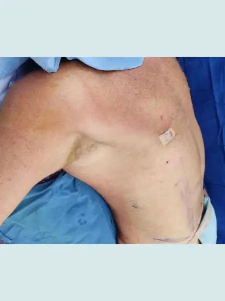 Male Circular Tummy Tuck with Lipo 360