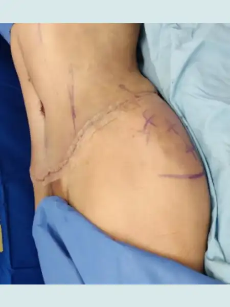 Tummy Tuck