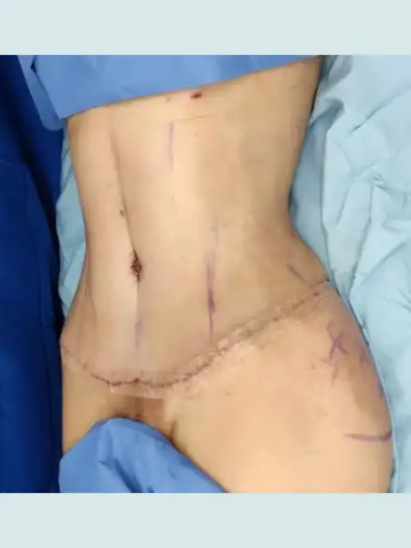 Tummy Tuck