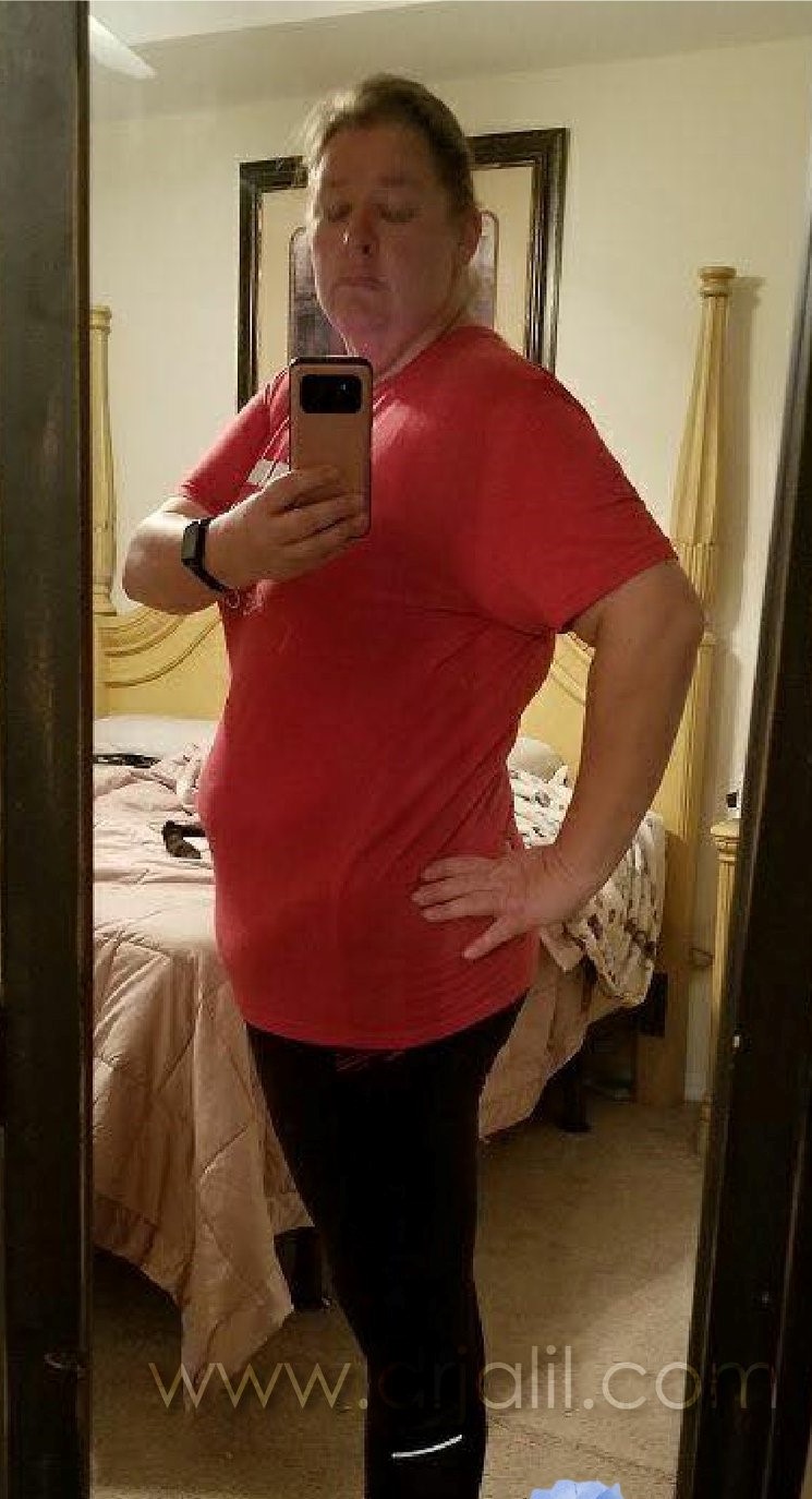 Weight-Loss Surgery