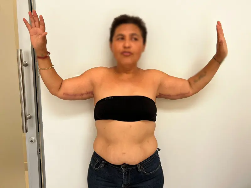 Arm Lift