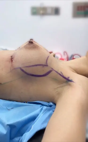 Breast Augmentation