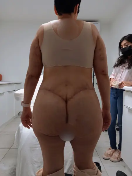 Circular Tummy Tuck Lipo and BBL