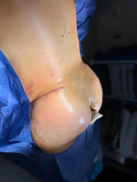 Extended Tummy Tuck with BBL and Lipo