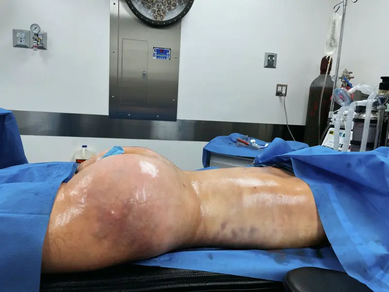 Lipo and BBL