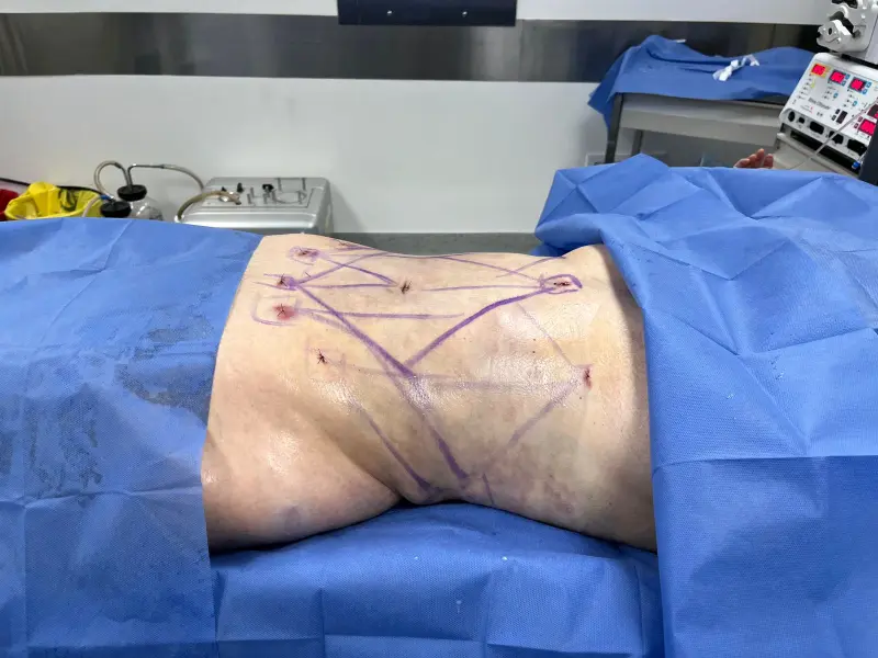 Lipo and BBL