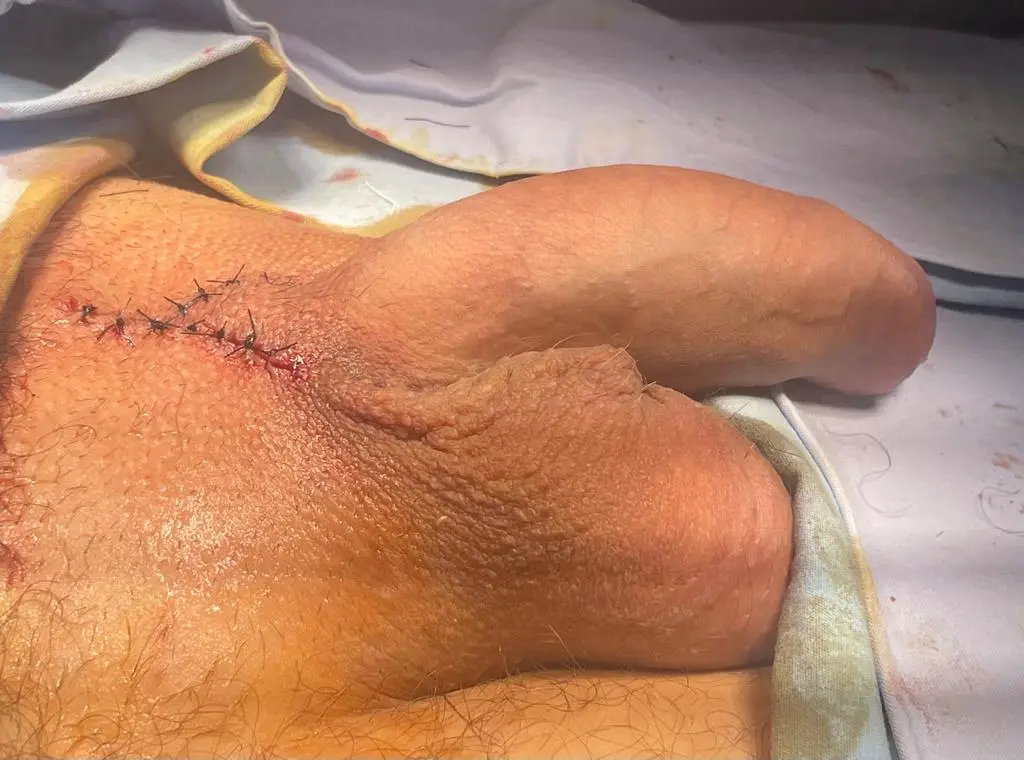Penis Enlargement