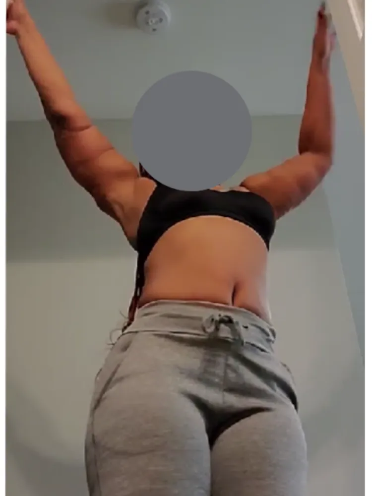 Arm Lift