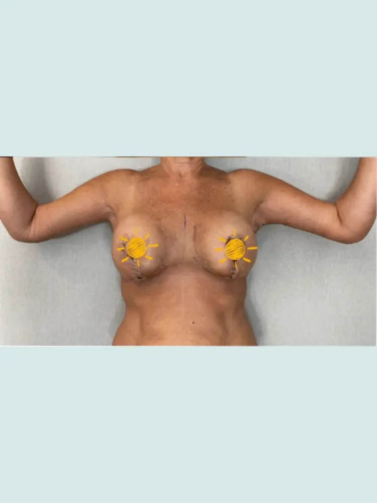 Breast Lift & Arm Lift 