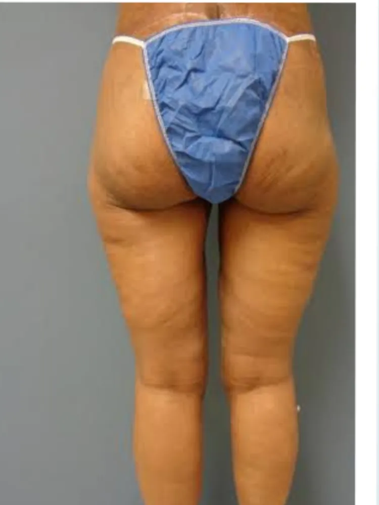 Thigh Lift