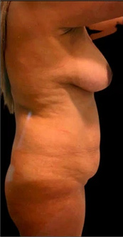Tummy Tuck