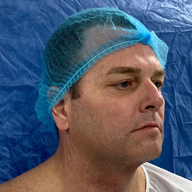 Full Facelift w/ Rhinoplasty