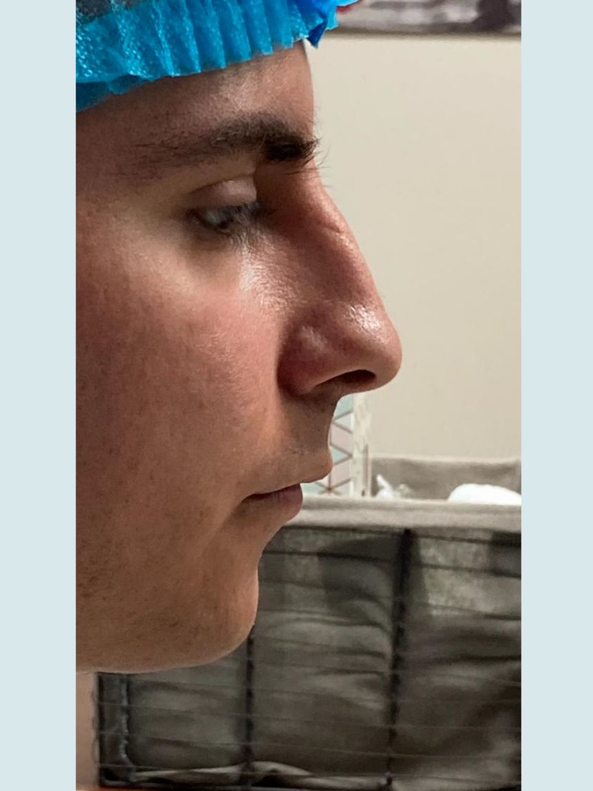 Rhinoplasty