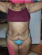 Fleur De Lys Tummy Tuck