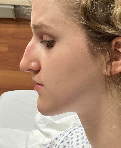 Rhinoplasty