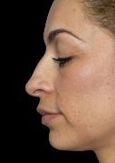 Rhinoplasty