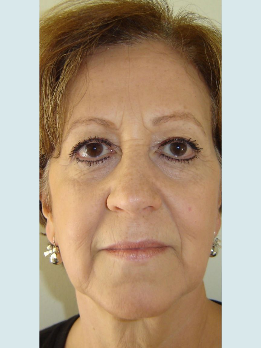 Facelift