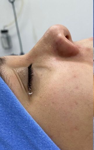 Rhinoplasty
