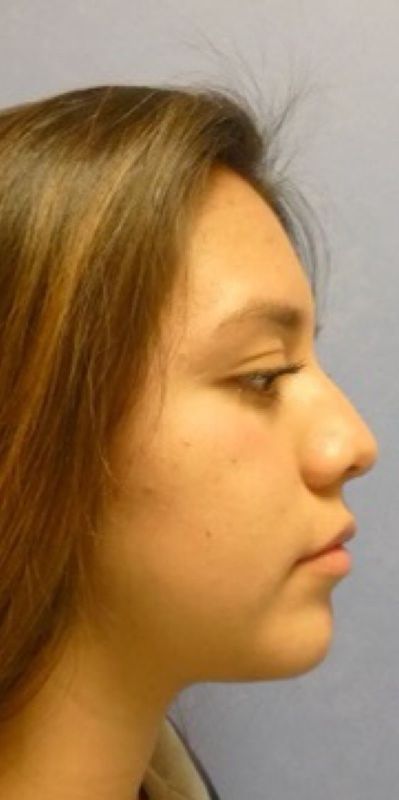 Rhinoplasty